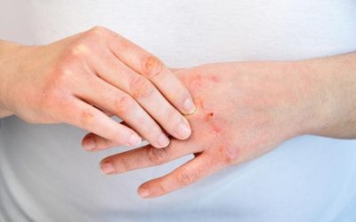 En el mes de su conmemoración: Psoriasis y su relación con la salud mental