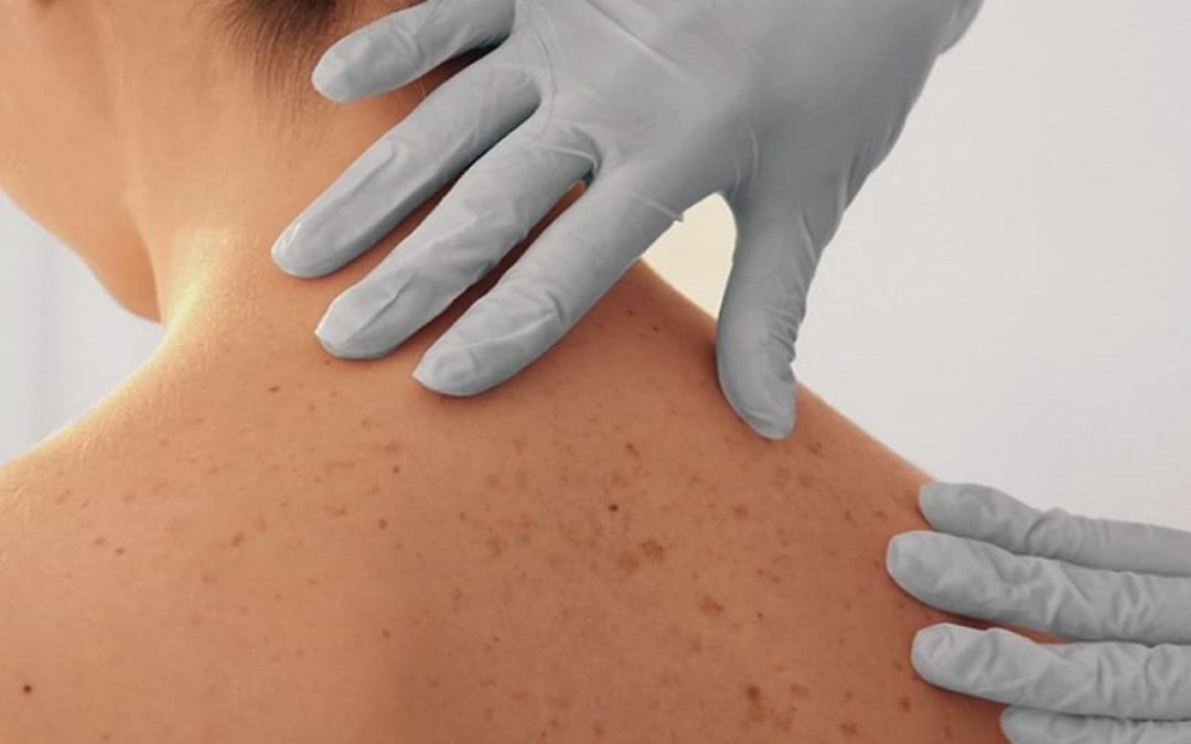 Chequeos gratuitos para concientizar sobre el cáncer de piel