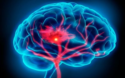 Semana Mundial de la Prevención del Accidente Cerebrovascular (ACV)