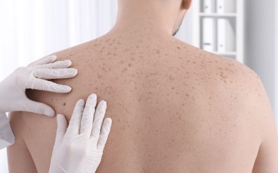 Día Mundial del Melanoma. Cuáles son las señales que permiten detectarlo de forma precoz