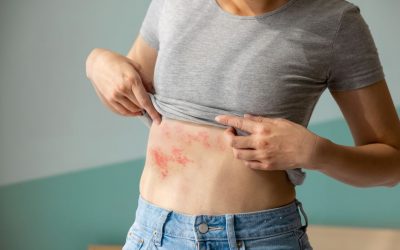 Herpes zóster: personas inmunocomprometidas y adultos mayores entre los grupos más afectados